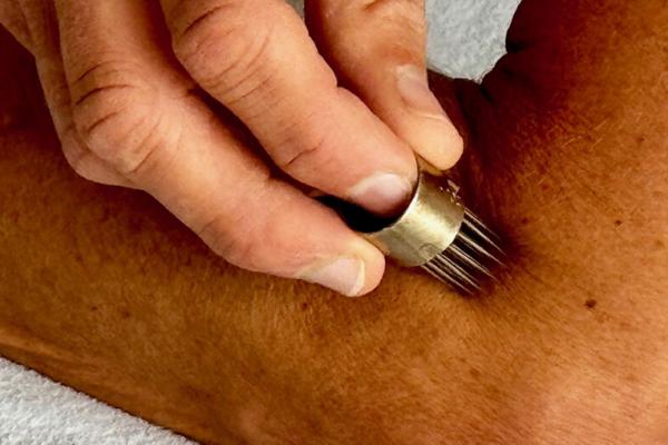  Baunscheidtverfahren